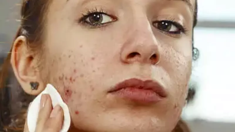 Bid Farewell to Hormonal Acne: 7 Powerful Natural Remedies That Actually Work