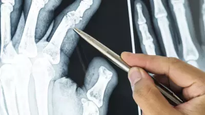 7 Essential Tips to Prevent Frequent Bone Fractures Naturally