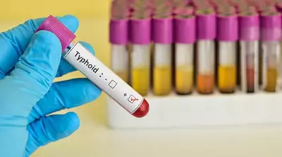 NHRC Demands Report from Gujarat on Typhoid Outbreak Within 14 Days