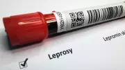 Maharashtra Takes Historic Step: Leprosy Now a Notifiable Disease Across the State