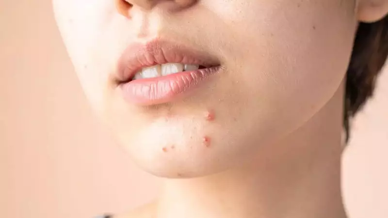 Bid Farewell to Acne Scars: Your Ultimate Treatment & Post-Acne Care Guide