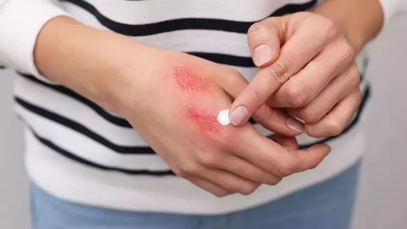 Diwali Sanitiser Handshake Burns? Expert Tips For Quick Hand Recovery