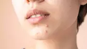 Bid Farewell to Acne Scars: Your Ultimate Treatment & Post-Acne Care Guide
