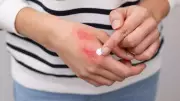 Diwali Sanitiser Handshake Burns? Expert Tips For Quick Hand Recovery