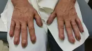 Lung Cancer Warning: Don't Ignore These Finger Changes - Nail Clubbing Could Signal Serious Health Risk