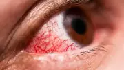 Pollution Eye Crisis: 5 Dangerous Conditions Spiking Across India - Early Symptoms You MUST Know