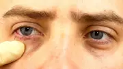 Your Eyes Are Talking: 5 Warning Signs That Reveal Hidden Health Problems