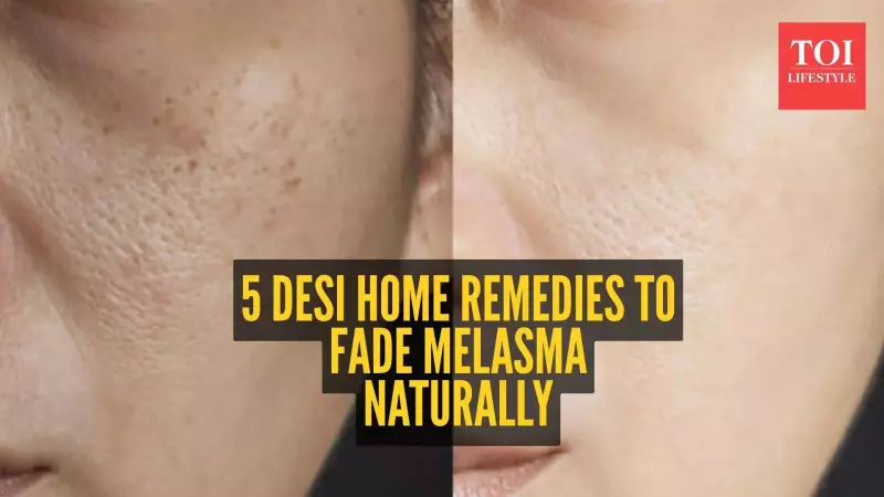 5 Natural Home Remedies to Treat Melasma (Jhai) Effectively