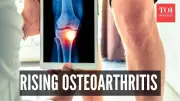 Arthritis No Longer Just For Seniors! Why Young Indians Are Developing Osteoarthritis
