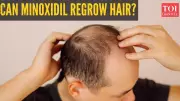 Minoxidil's Viral Comeback: Research Reveals Who Really Benefits
