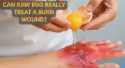 Egg White Burn Remedy: Viral Hack Debunked by Doctors as Dangerous