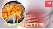 Top Gastroenterologist Reveals 3 Daily Drinks to Reverse Fatty Liver