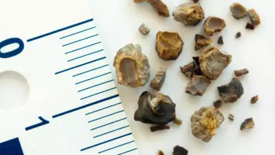 3 Simple Diet Tips from AIIMS Neurologist to Prevent Kidney Stones