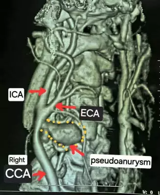 Chhattisgarh Doctors Achieve Rare Feat, Save Man from Spontaneous Neck Artery Rupture