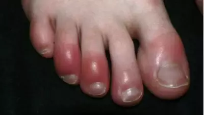 Chilblains in Winter: Why Fingers & Toes Turn Red, Itch and How to Prevent