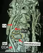 Chhattisgarh Doctors Achieve Rare Feat, Save Man from Spontaneous Neck Artery Rupture