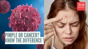 Not a Pimple: Dermatologist Warns of Skin Cancer That Mimics Common Bumps