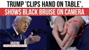 Trump Dismisses Hand Bruise Concerns After Davos Appearance Sparks Health Speculation