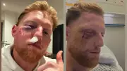 Ben Stokes Undergoes Surgery After Cricket Ball Facial Injury in Nets