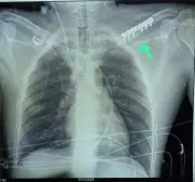 Doctors in Raipur Save Man's Arm with Complex Surgery After Knife Attack