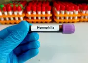 Haemophilia: A Rare Genetic Disorder That Can Be Managed Effectively