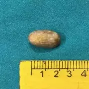 Kolkata Doctors Save Teen by Removing Large Seed from Lung in Critical Surgery