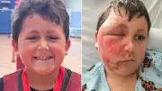 Nine-Year-Old Suffers Severe Burns in Viral TikTok Challenge, Authorities Issue Warning
