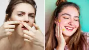 Pimple Patches: Dermatologist Reveals If They're Effective or Just Hype
