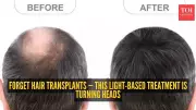 South Korean Scientists Develop Light-Based Hair Growth Cap with 92% Reduction in Ageing Markers