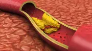 Understanding Cholesterol: The Good, The Bad, and How to Manage It for Heart Health