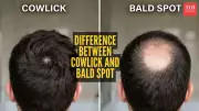 Cowlick vs Bald Spot: How to Tell the Difference and Stop Panicking