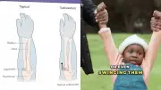 Doctor's Viral Instagram Reel Educates Parents on Common Child Arm Injury