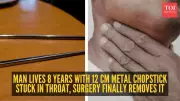 Man Lives 8 Years with Metal Chopstick in Throat, Doctors Finally Remove It