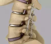 Middle East Conflict Disrupts Titanium Implant Supply, Threatens Patient Care in India