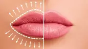 Natural Look Lip Fillers Trend Explained by Beauty Experts