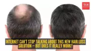 New Triple-Threat Hair Loss Treatment Shows Stunning Results in Pilot Study