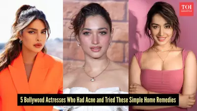 5 Bollywood Celebrities Who Beat Acne with DIY Home Remedies