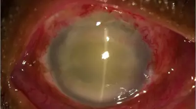 Indian Study Reveals Alarming Drug-Resistant Eye Infections