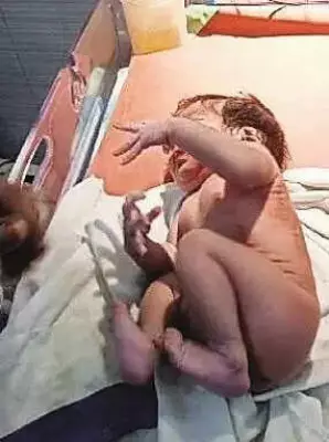 Low-Birth-Weight Baby Saved Under Mukh Mantri Sehat Yojana in Bathinda