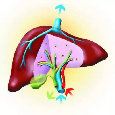 Mumbai Hospital Performs Rare Liver Swap Transplant Between Incompatible Blood Groups