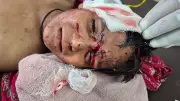 9-Year-Old Boy Critically Injured in Stray Dog Attack in Sirsa Village, Haryana