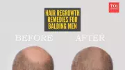 Natural Hair Regrowth for Men: Effective Home Remedies and Realistic Expectations