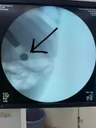 Noida Doctors Save Toddler After She Swallows Lithium Button Battery from Toy