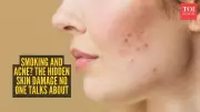 Smoker's Acne: How Cigarettes Sabotage Your Skin Health