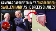 Trump's Discolored Hand Sparks Health Concerns During King Charles Visit