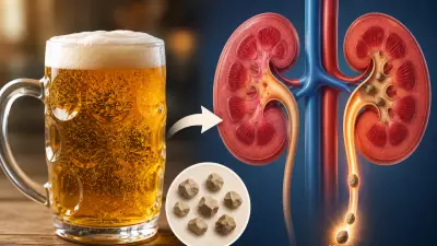 Beer for Kidney Stones? Doctors Debunk Viral Myth and Warn of Risks