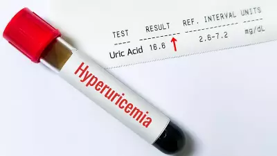 Silent Uric Acid Crisis: 1 in 4 Indians at Risk
