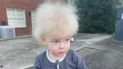 5 Bizarre Human Syndromes That Sound Unbelievable But Are Real