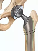 91-Year-Old Mumbai Man Undergoes Hip Replacement to Avoid Bed Rest