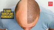 Hair Transplant Permanence: 500-Case Study Reveals Long-Term Results